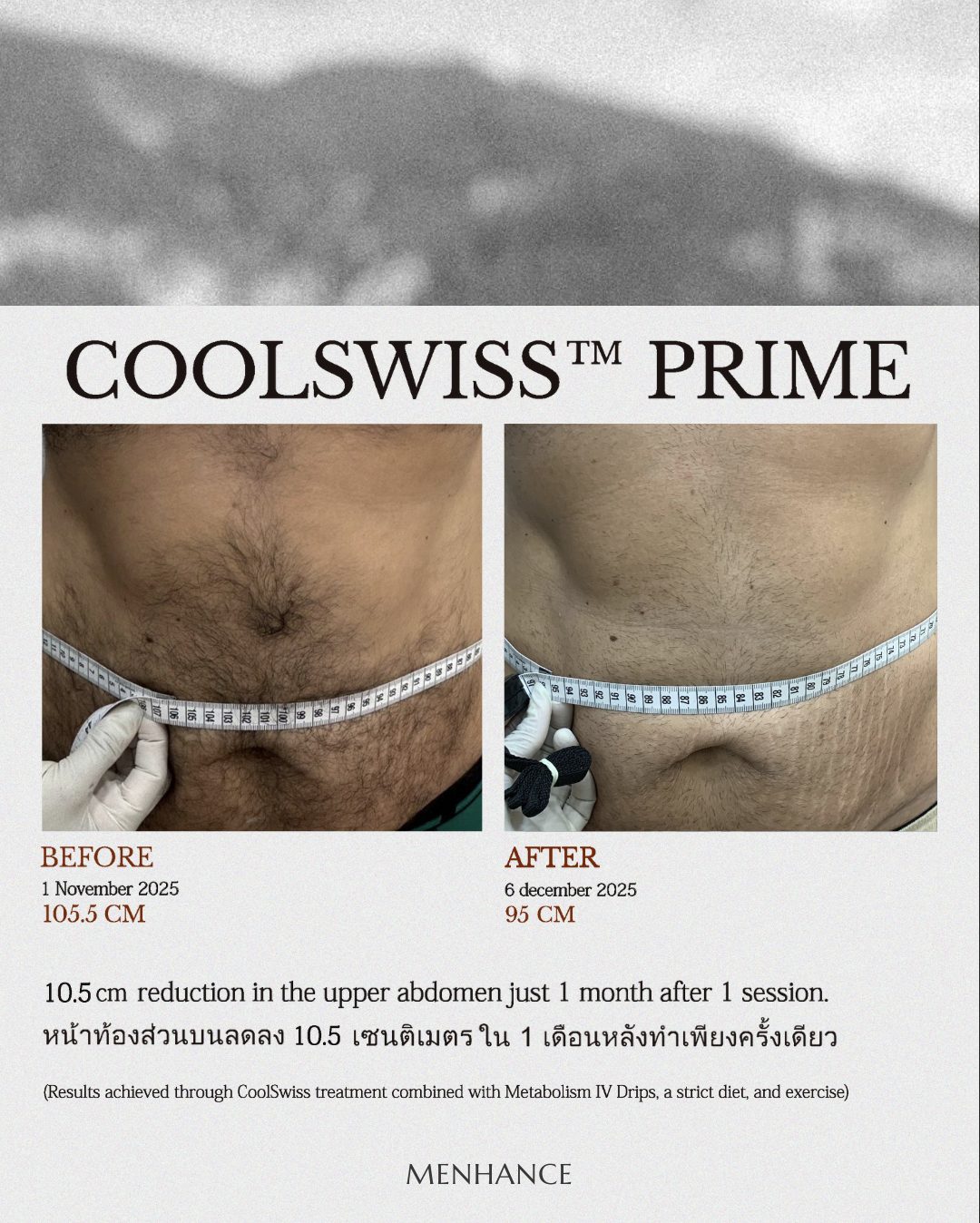 CoolSwiss Prime before and after — lower abdomen, 5 cm reduction