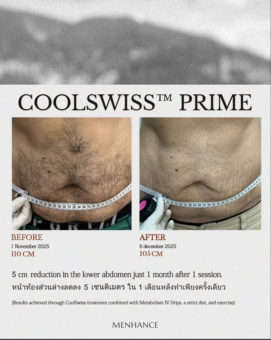 CoolSwiss Prime before and after — upper abdomen, 10.5 cm reduction